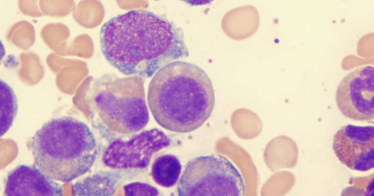 Myelodysplastic image