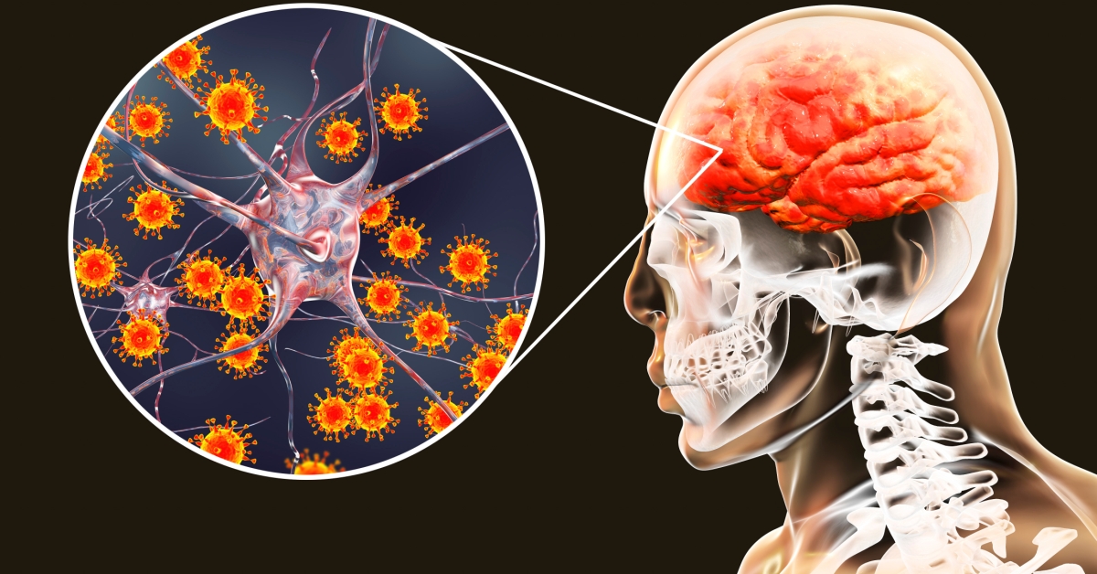 Neurosyphilis image