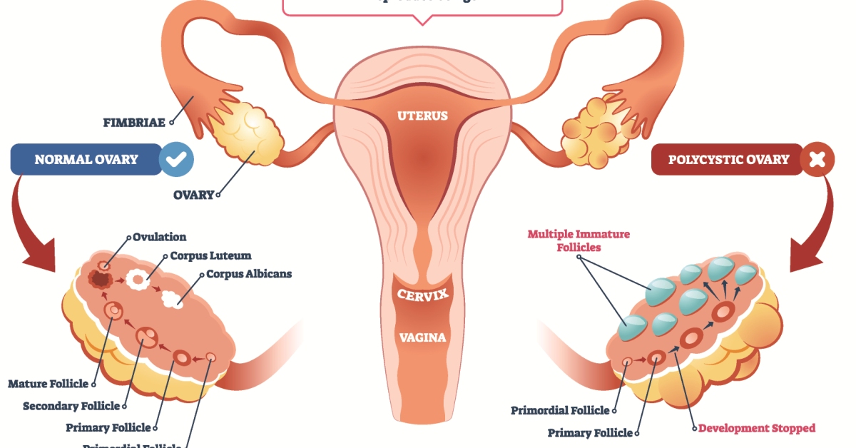 PCOS - Polycystic Ovary Syndrome image
