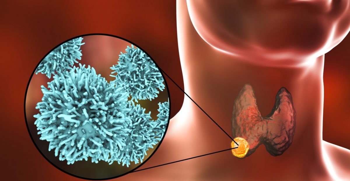 Papillary Thyroid Cancer image