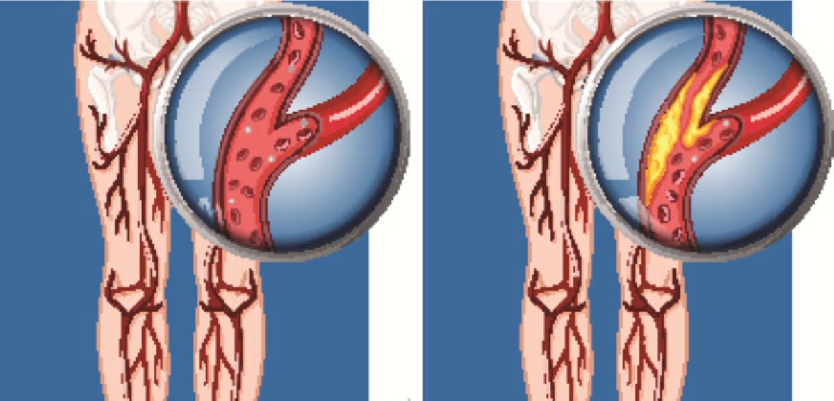 Peripheral Artery image