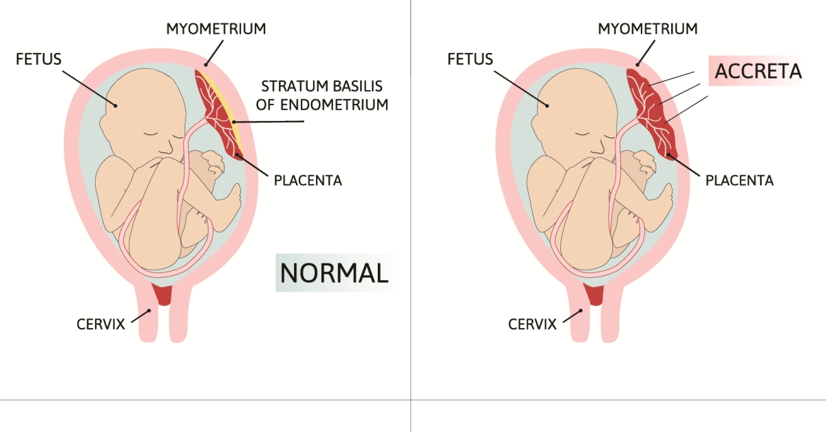 Placenta Accreta image