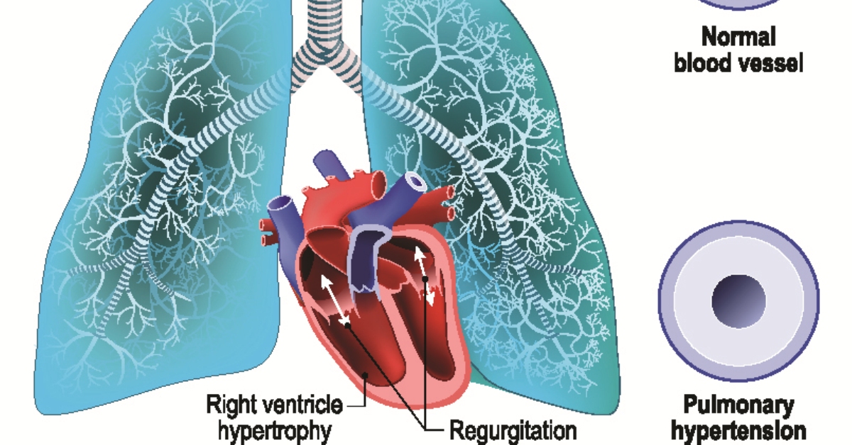 Pulmonary Hypertension image