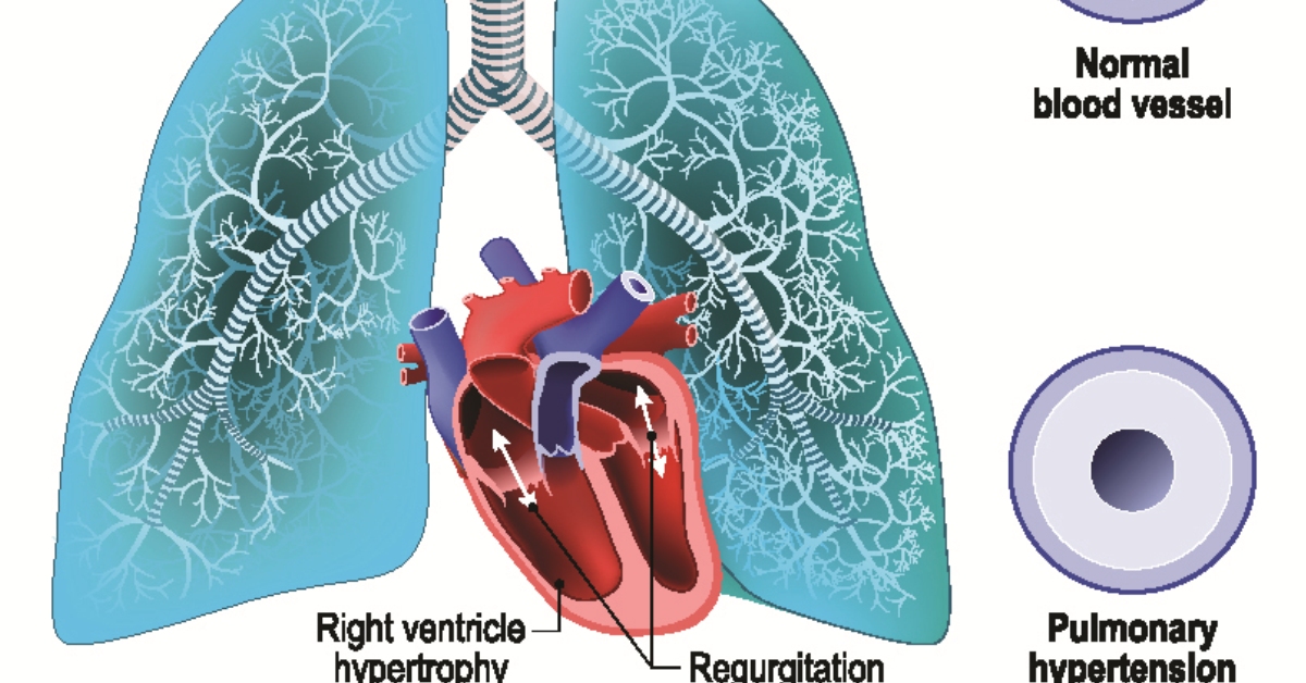Pulmonary Regurgitation image