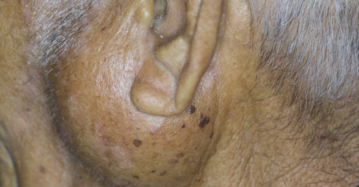 Salivary Gland cancer image