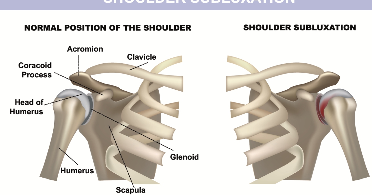 Shoulder Subluxation image