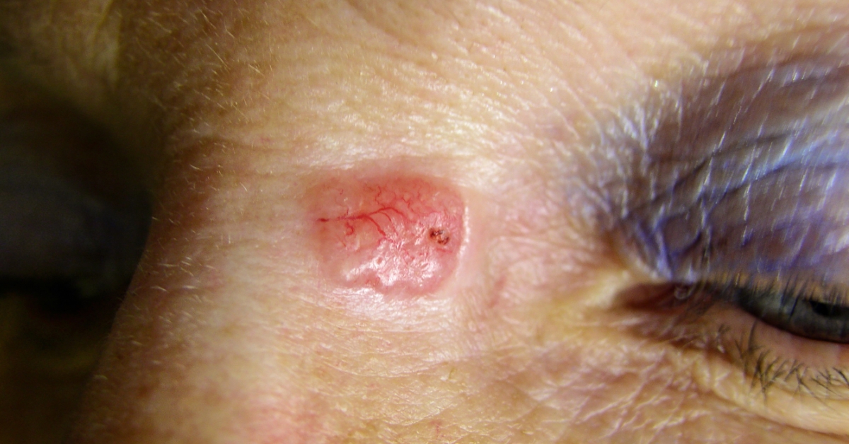 Skin Cancer on Nose image