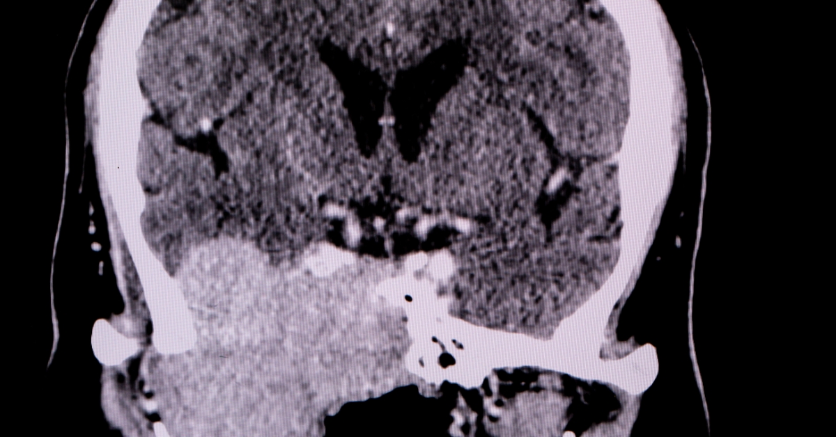 Skull Base Tumor image