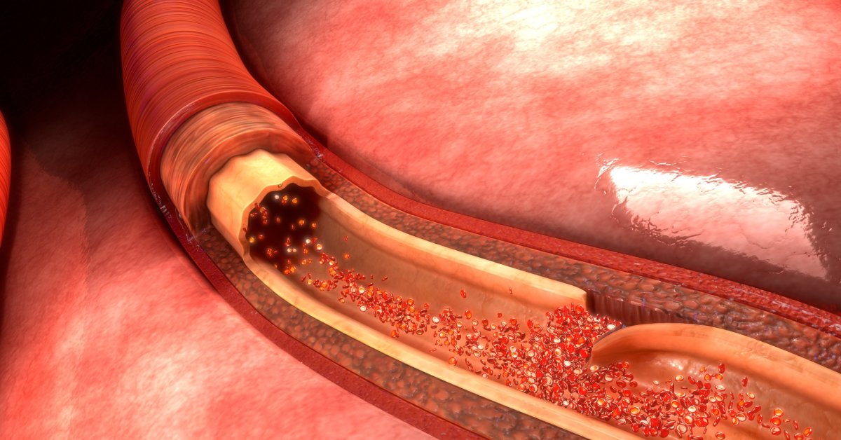 Spontaneous Coronary Artery Dissection image