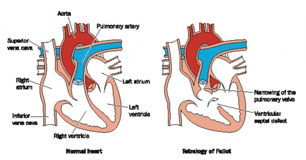 Cost Of Tetralogy Of Fallot Correction (tof) In India