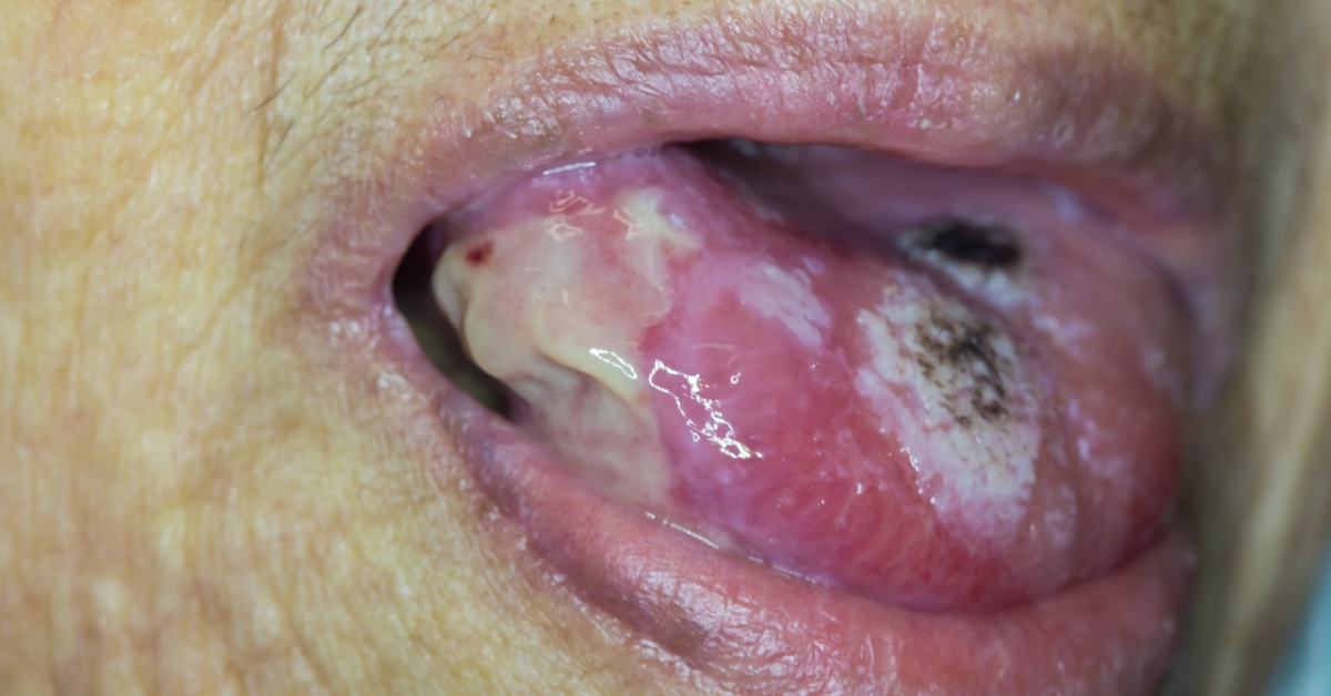 Tongue Cancer image
