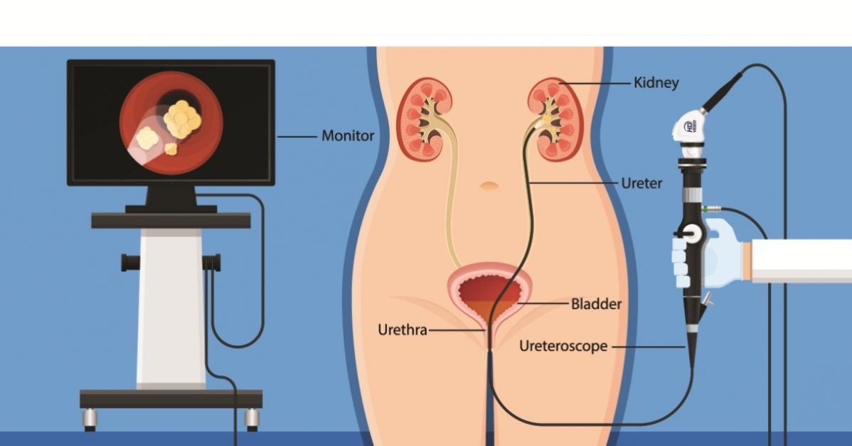 ovarian cysts image