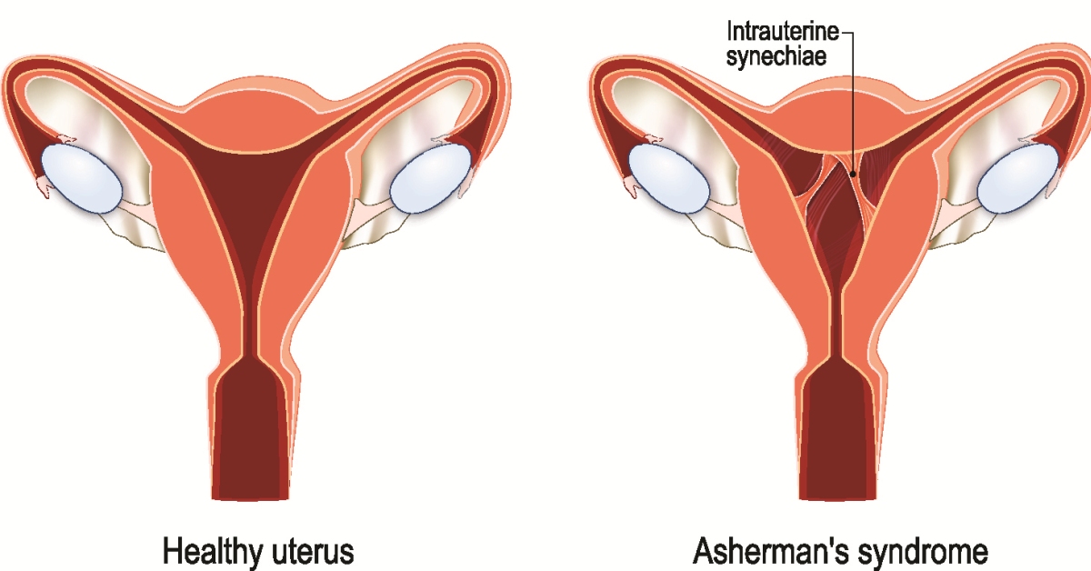 Asherman Syndrome (Intrauterine Adhesions) image