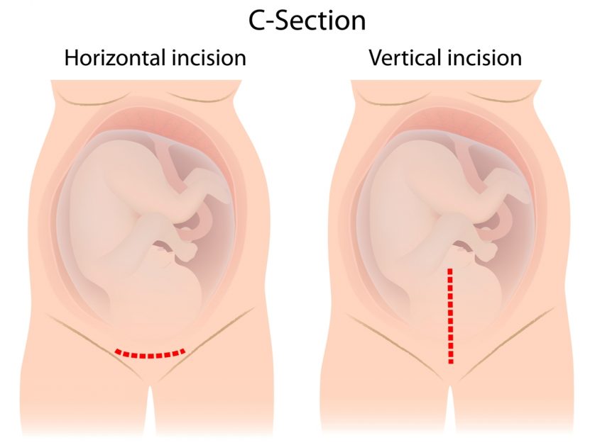 C-Section image
