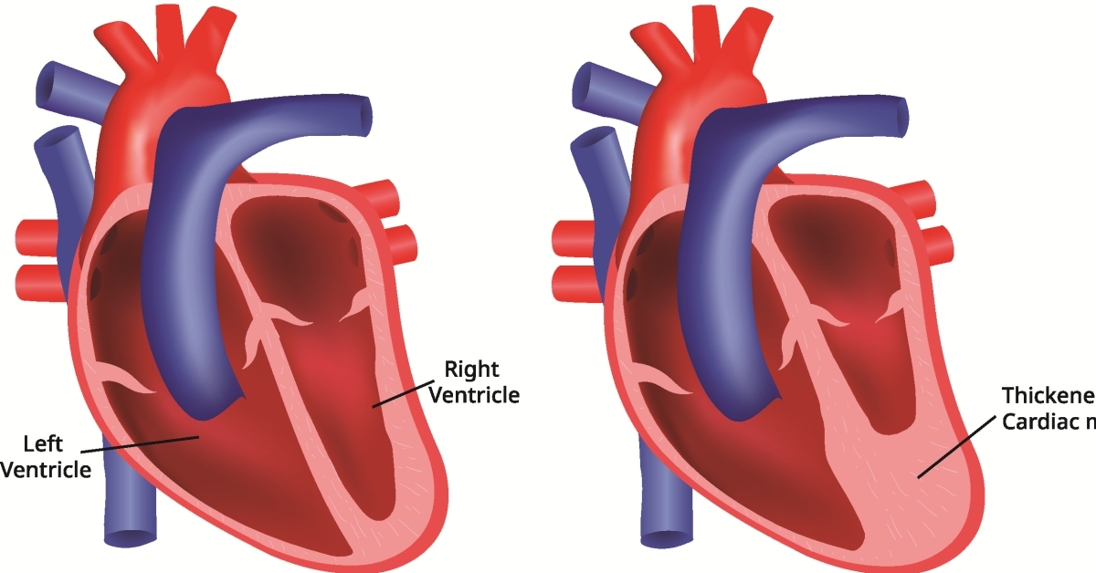 Cardiac Tamponade image