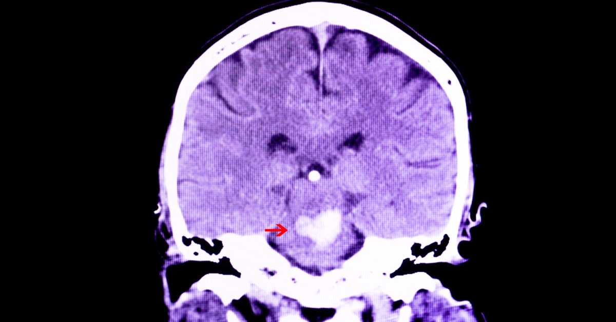 Craniopharyngioma image