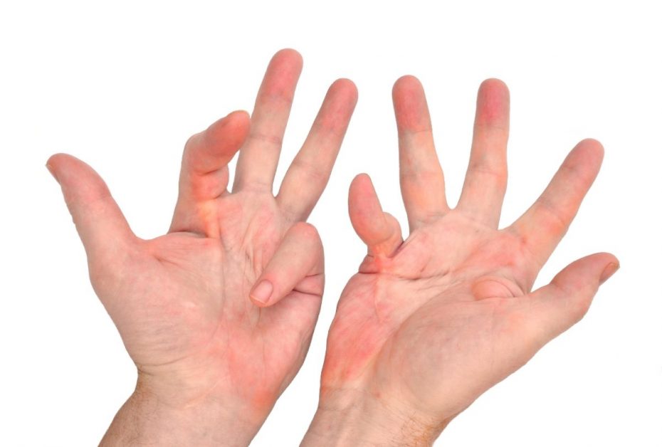Dupuytren's Contracture image