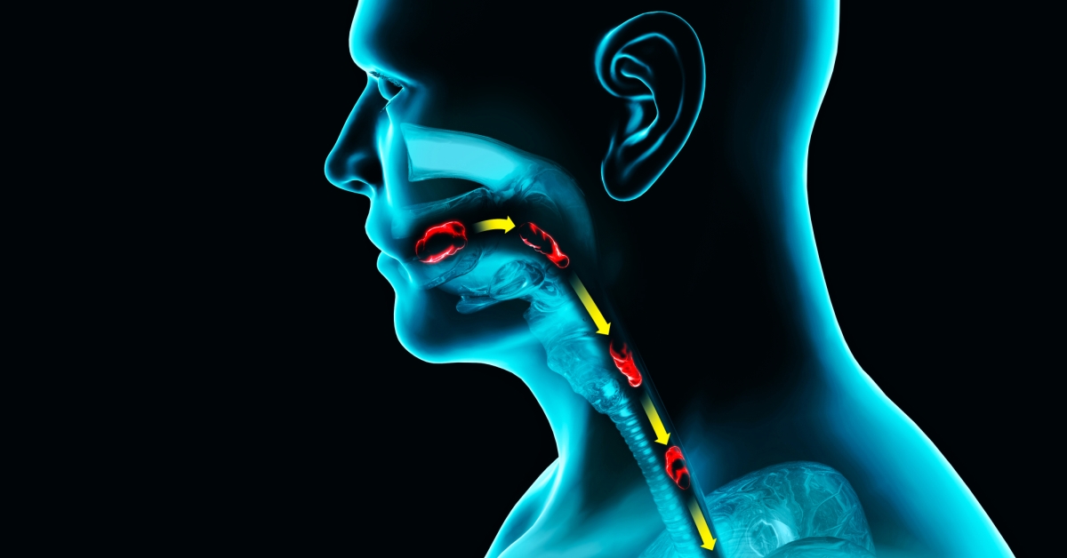 Esophageal Spasms image