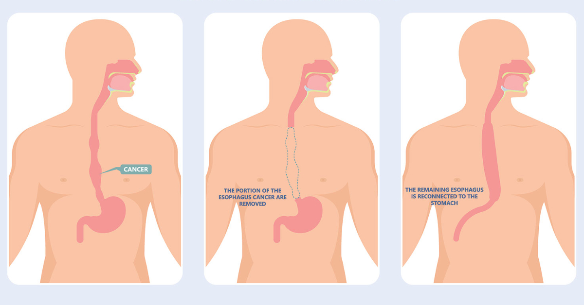 Esophagectomy Image