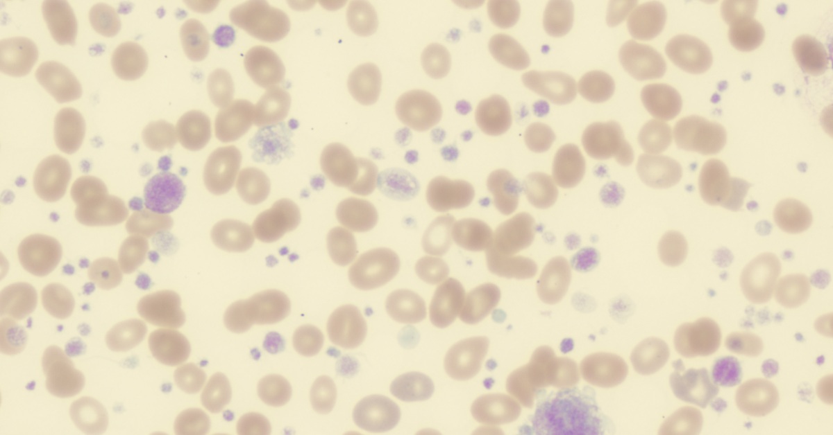 Essential Thrombocythemia image