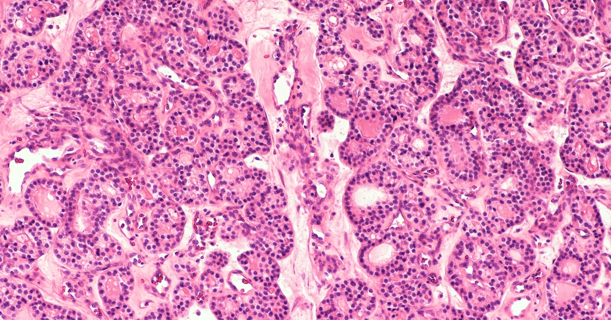 Medullary Carcinoma image