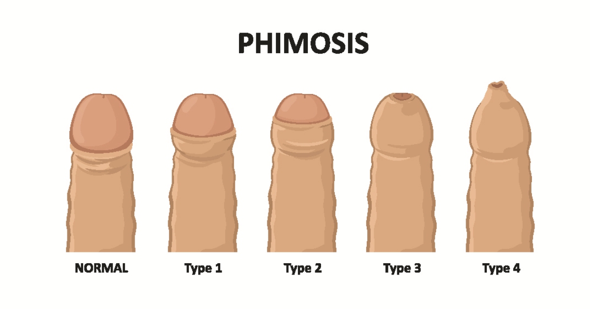 Phimosis image