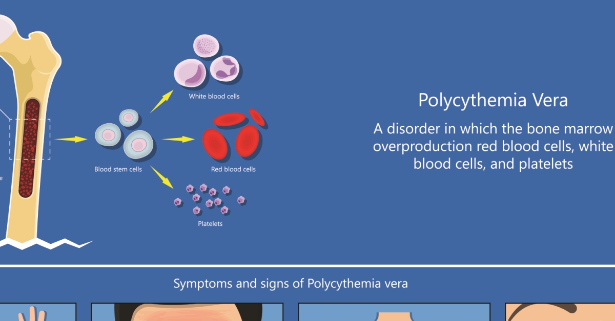 Polycythemia Vera image