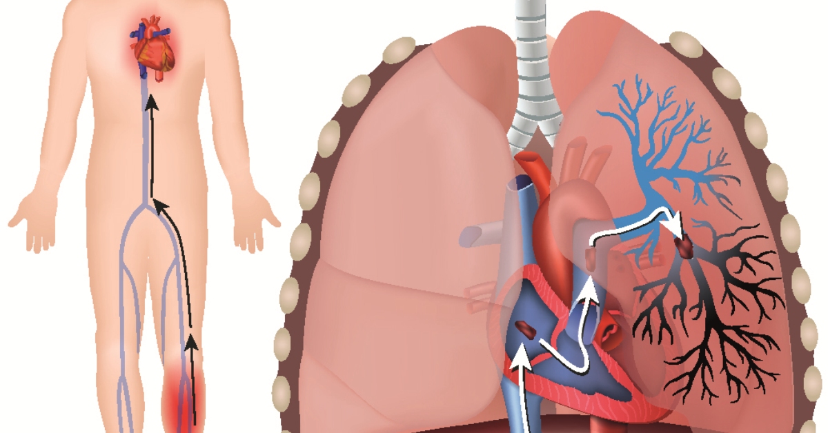 Pulmonary Embolism image