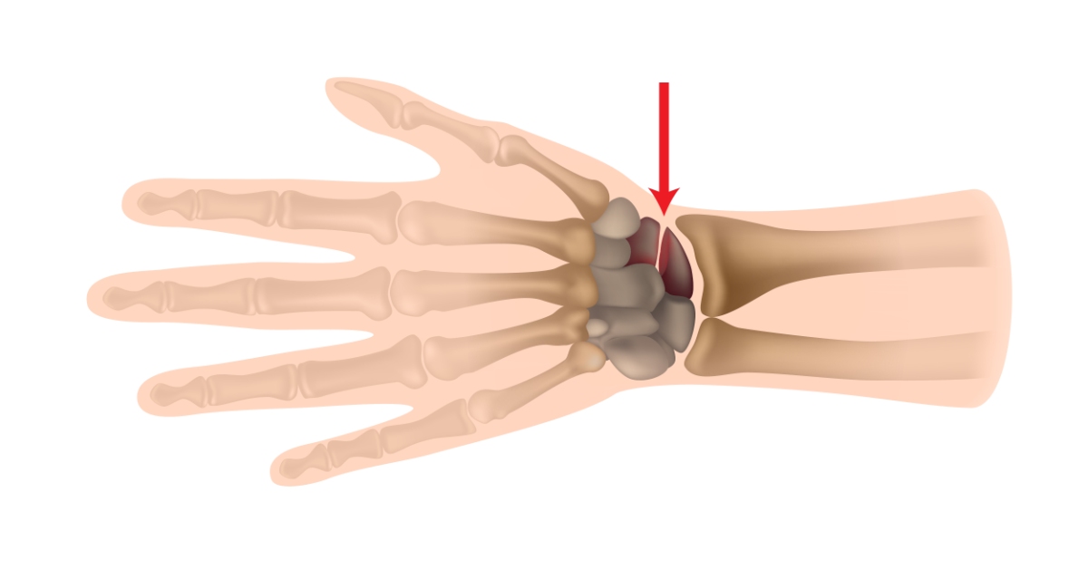 Scaphoid Fracture image