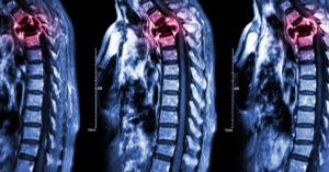 Spinal Cord Tumors