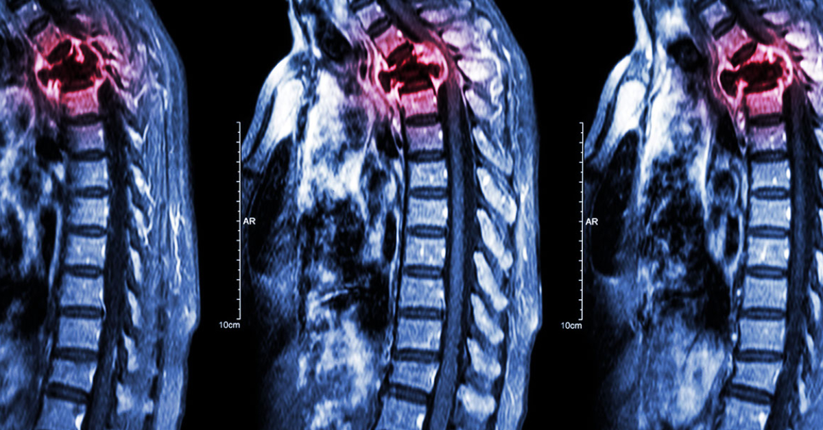 Spinal Cord Tumors