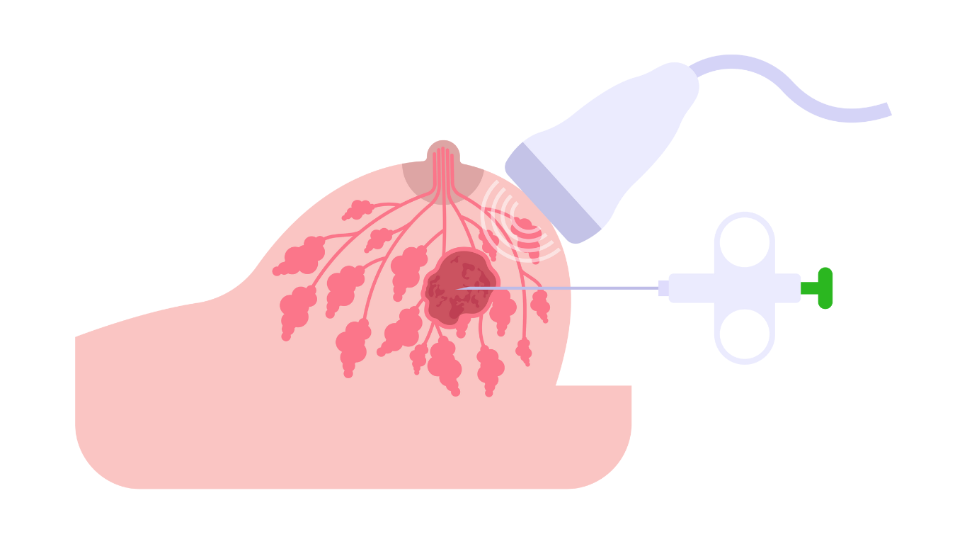 Sentinel Node Biopsy