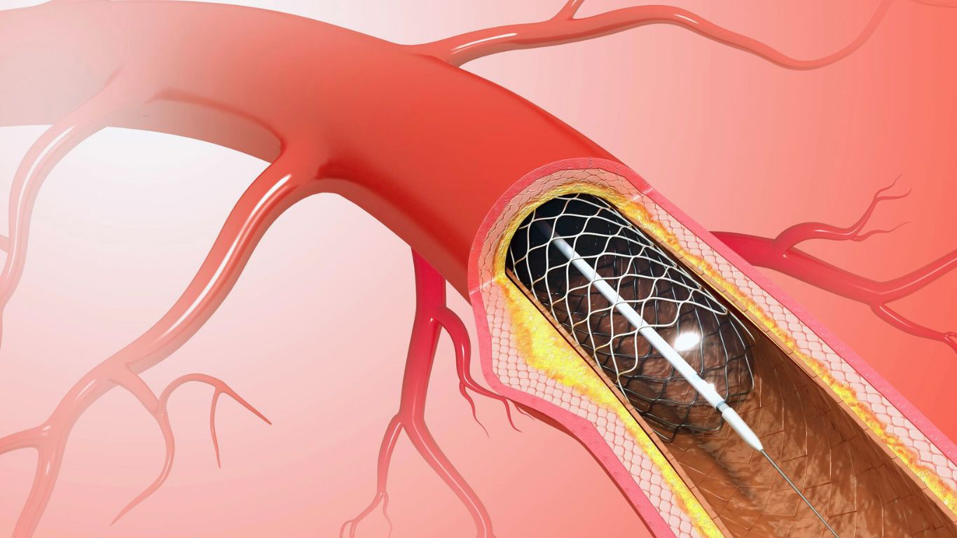 Balloon angioplasty