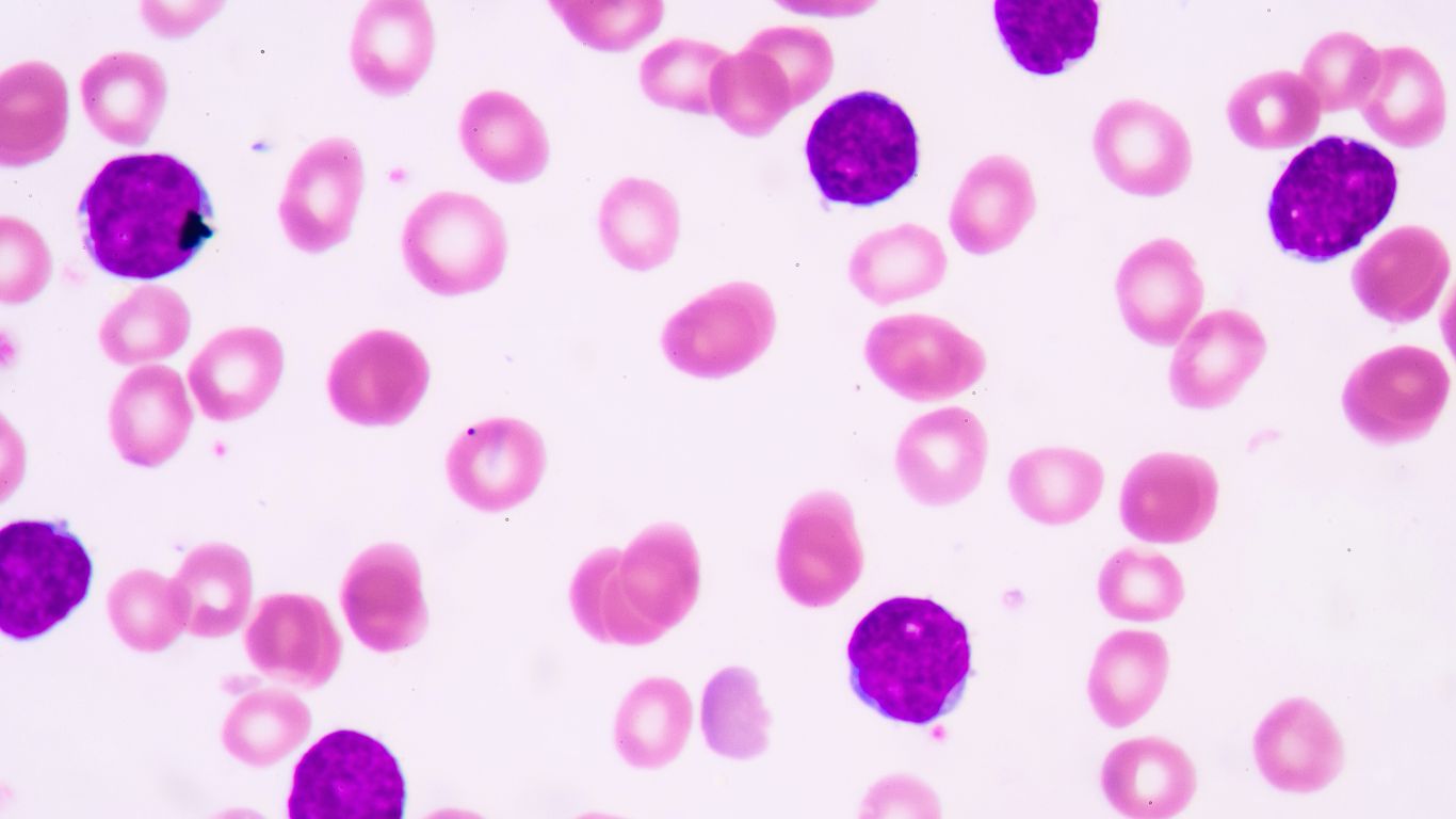 Acute lymphoblastic leukemia