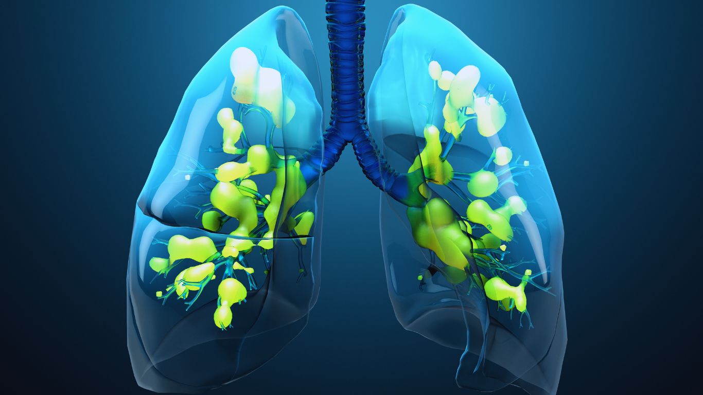 Acute Respiratory Distress Syndrome (ARDS)