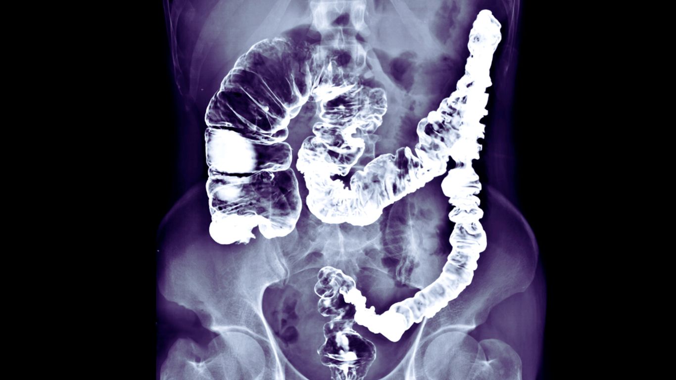 barium enema