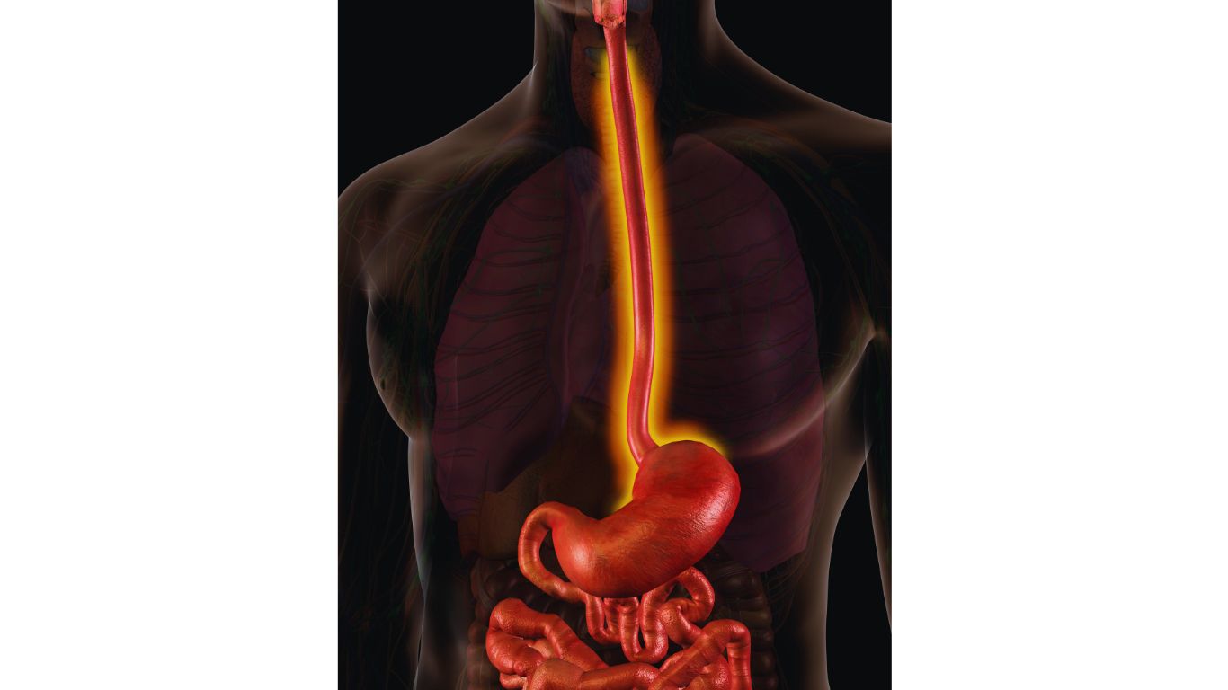 Barrett's esophagus