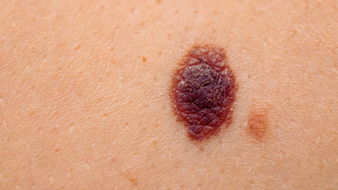 Melanoma