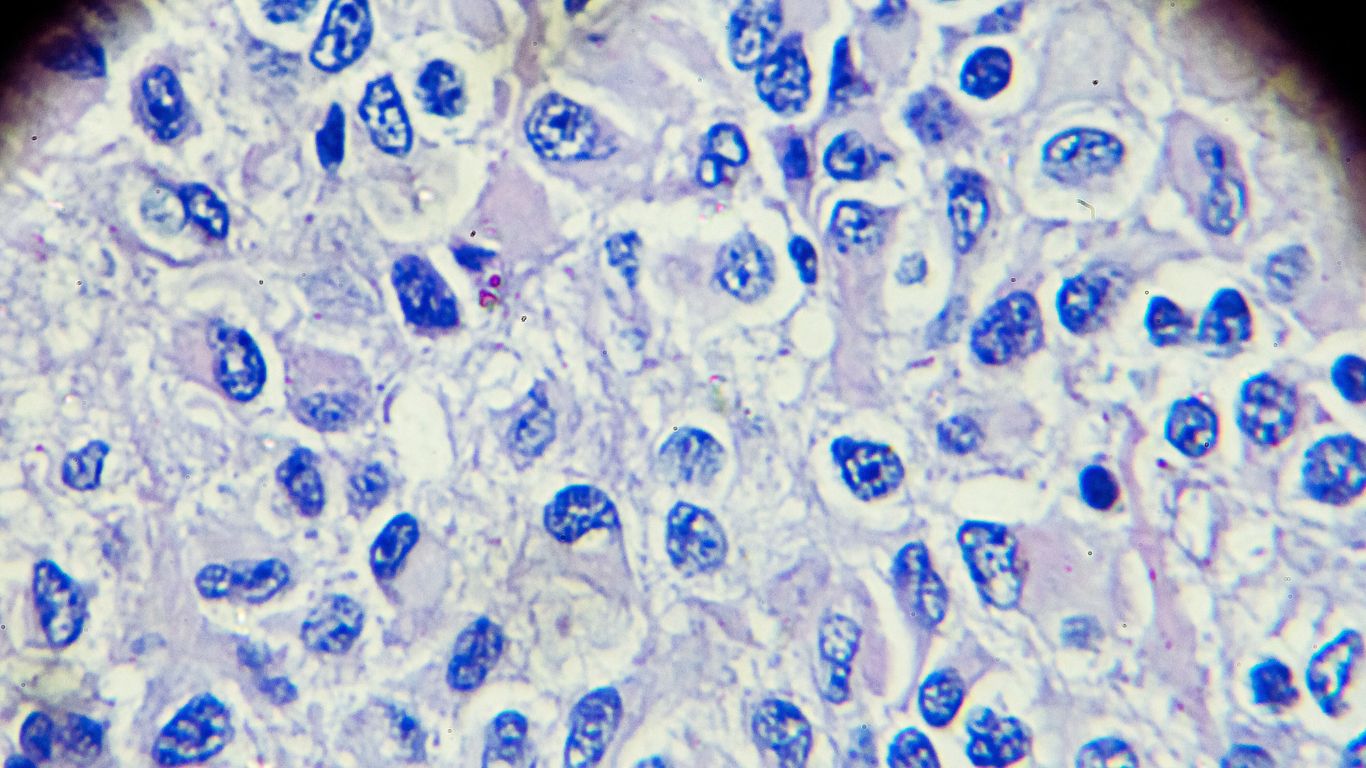 Ovarian germ cell tumors