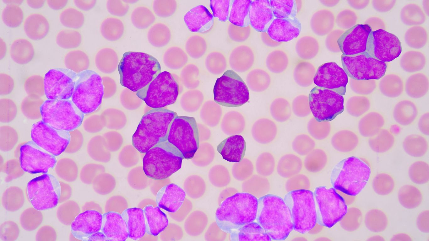 Acute Myelogenous Leukemia