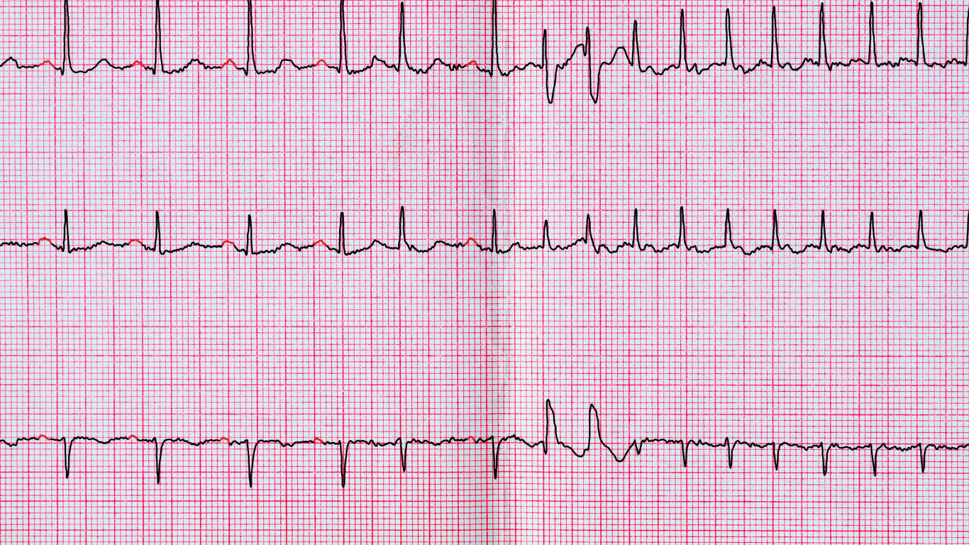 Ventricular Fibrillation