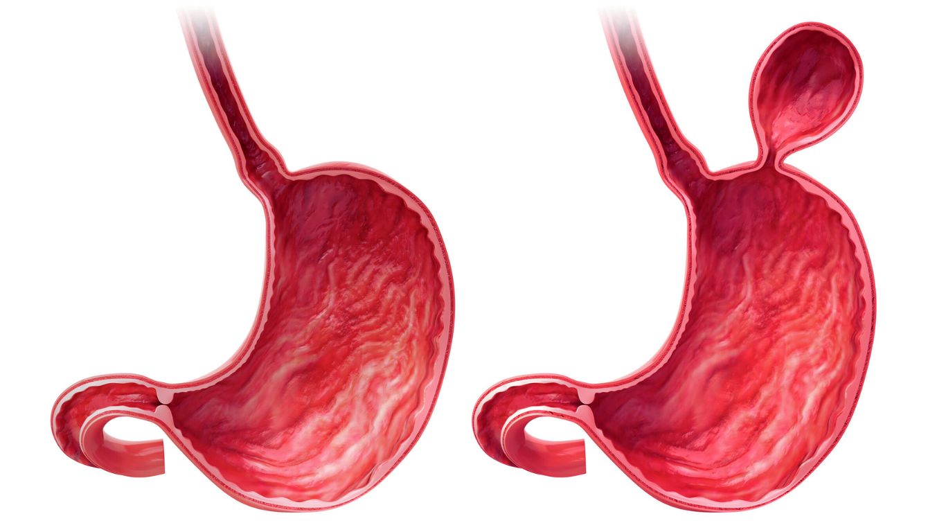 Hiatal Hernia