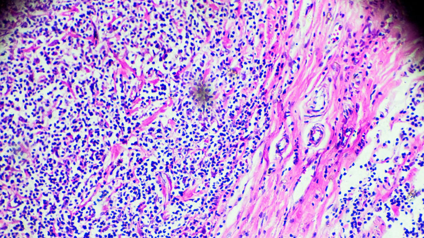 Hodgkin's Lymphoma (HL)