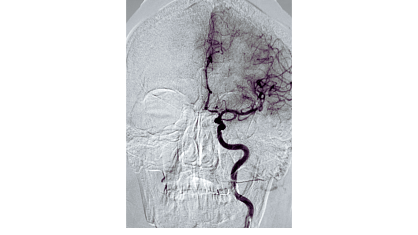 Moyamoya Disease