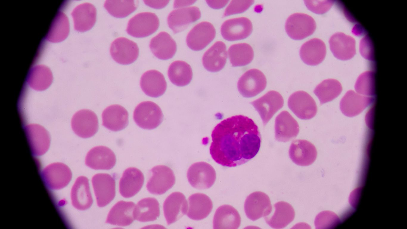 Churg-Strauss Syndrome